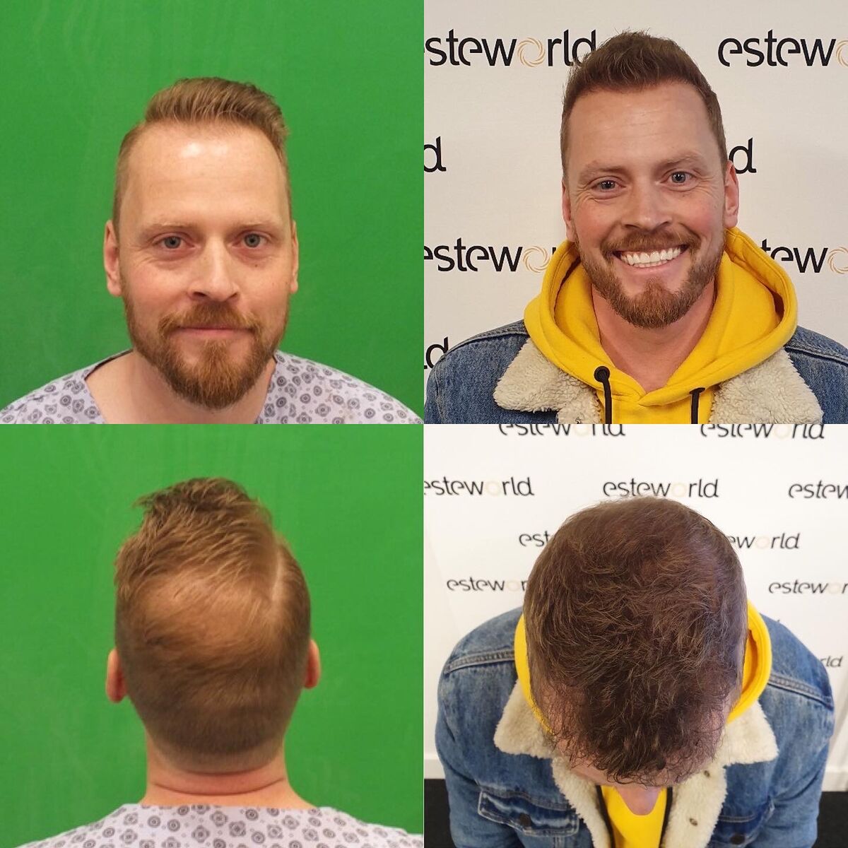 Mijn haartransplantatie resultaat is bekend!