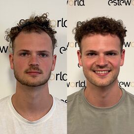 Door research (haarweb, etc.) voor haartransplantatie in Turkije gekozen.