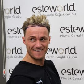 Jari Hellegers dhi methode hoge haarlijn correctie