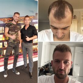 Don Resultaat haartransplantatie Turkije + Acell