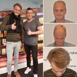Naar Turkije voor een haartransplantatie! JA! Bij Esteworld haartransplantatie.