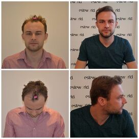 Manuel blij met zijn haartransplantatie resultaat!