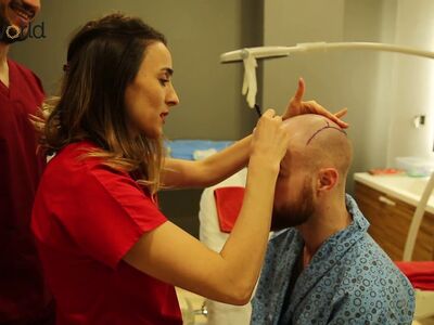 Goedkoopste haartransplantatie in Turkije