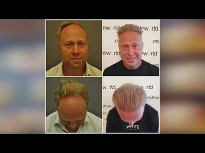 4200 grafts goedkope haartransplantatie Turkije