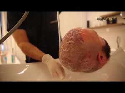 Hoe verloopt het herstel na een haartransplantatie?