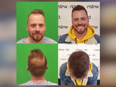 Eelke, haartransplantatie Turkije met 100% aandacht