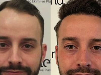 Joren haartransplantatie turkije