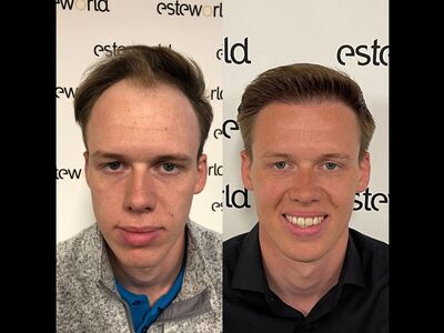 Haartransplantatie bij Esteworld? Aanrader!