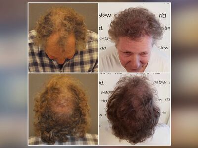 Harri,  super haartransplantatie Turkije