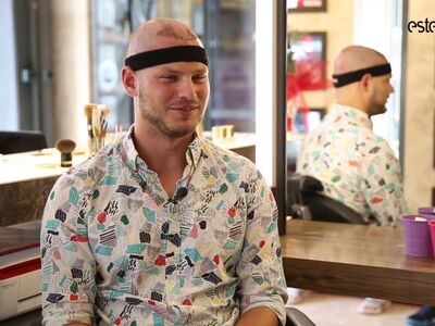 Wat is een haartransplantatie