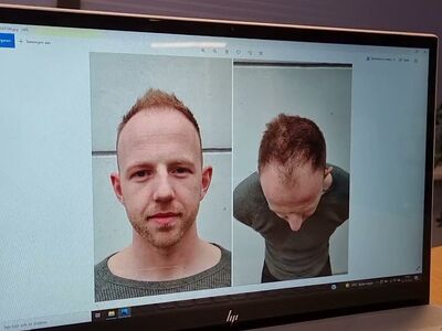 Jordy eindresultaat haartransplantatie