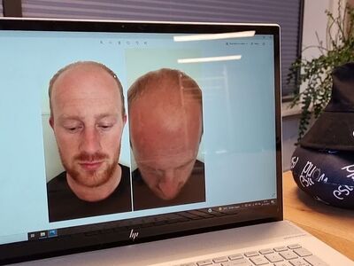 Oprecht heel tevreden haartransplantatie resultaat