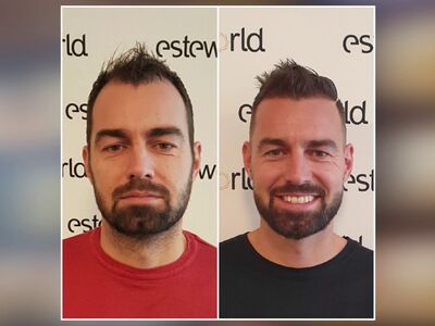 Vanuit België een haartransplantaie in Turkije