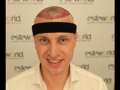 Kaal worden accepteren of actie. Voor mij Actie!