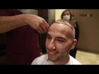 FUE saffier haartransplantatie ervaringen