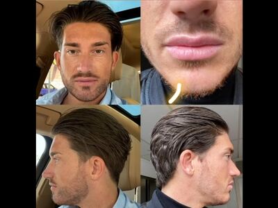 Baardtransplantatie ervaringen