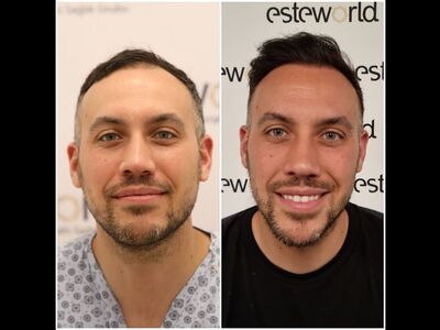 Mijn haartransplantatie reis naar Turkije