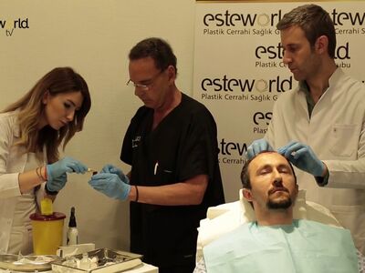 PRP in combinatie met een haartransplantatie