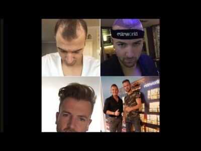 De verschillen tussen FUE Saffier, FUE CT en andere FUE-methode