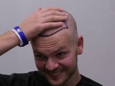 Door research (haarweb, etc.) voor haartransplantatie in Turkije gekozen.