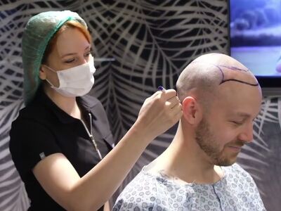 Als tiener al besloten, bij kaal een haartransplantatie