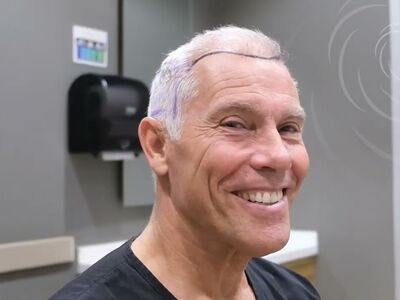 Haartransplantatie ook voor mensen boven de 60