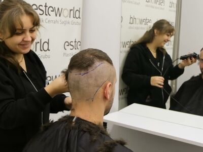 Tom, na verdoezelen met kapsels nu haartransplantatie