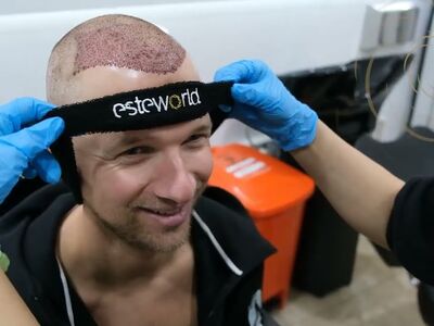 Teus, open en vertrouwelijke haartransplantatie intake in Nederland