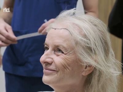 Haartransplantaties zonder scheren en de Long Hair methode