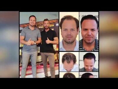 Betaalbare haartransplantatie Turkije