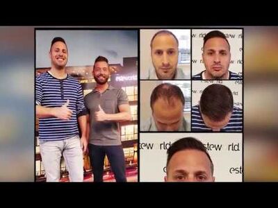 Haartransplantatie ziet er keurig uit, ben er echt blij mee!