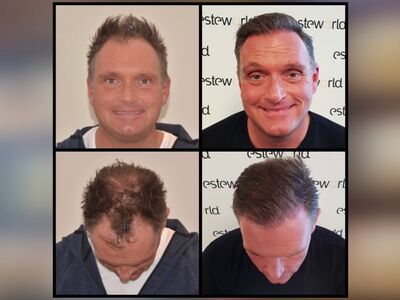 Nol, een 9 voor het hele proces van de haartransplantatie!