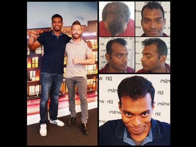 Kasan, 1/3de van kosten haartransplantatie in Nederland