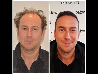 Hans de Vries, Lage kosten haartransplantatie voor goede kwaliteit!