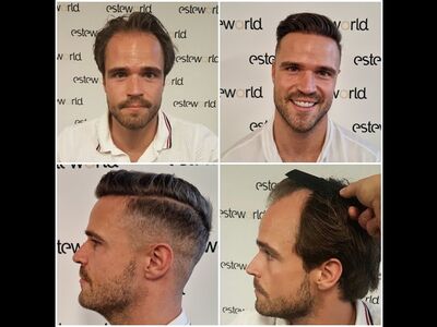 Als je haar langzaam verdwijnt? Haartransplantatie bij Esteworld! 