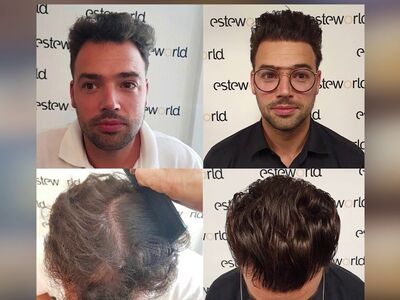 10+ voor de haartransplantatie in Turkije!