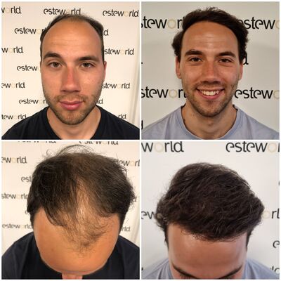 Jelmer, 100% vertrouwen in haartransplantatie resultaat