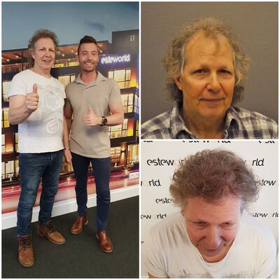 Harri,  super haartransplantatie Turkije