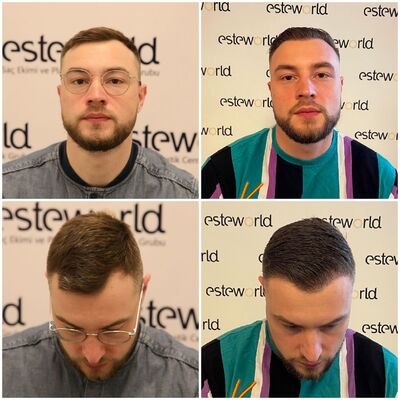 Gui voor haartransplantatie naar Turkije