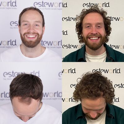 Bijzondere haartransplantatie ervaring