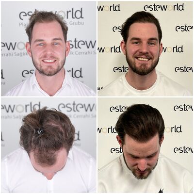 Word ik nou kaal, óf lijkt het alleen zo?