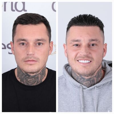 Davey Schiermanni: Ik wilde een lagere haarlijn