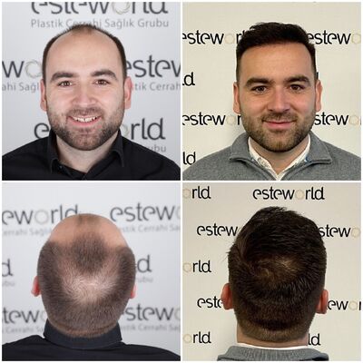 Mijn haartransplantatie resultaat is bekend!