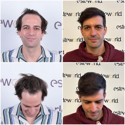 Na jarenlang onderzoek toch een haartransplantatie in Turkije