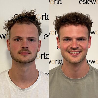 Door research (haarweb, etc.) voor haartransplantatie in Turkije gekozen.