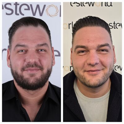 Joeri, zoals veel mannen begon ik kaal te worden