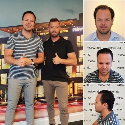 Betaalbare haartransplantatie Turkije