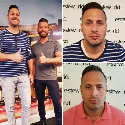 Haartransplantatie ziet er keurig uit, ben er echt blij mee!