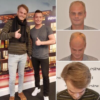 Naar Turkije voor een haartransplantatie! JA! Bij Esteworld haartransplantatie.