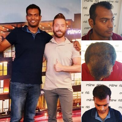 Kasan, 1/3de van kosten haartransplantatie in Nederland